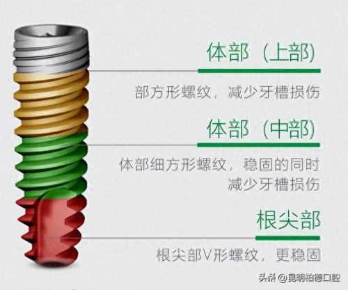 德国十大品牌种植体排行榜(进口种植体品牌有哪些)