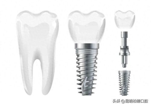 德国十大品牌种植体排行榜(进口种植体品牌有哪些)插图