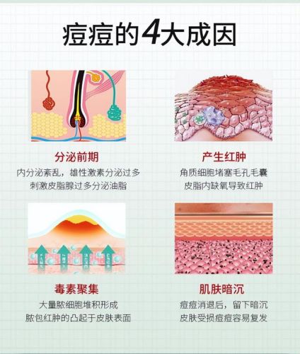 祛痘套装排行榜10强(祛痘套盒哪个牌子好)插图2