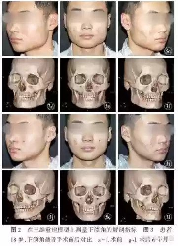 阵容脸骨头插图